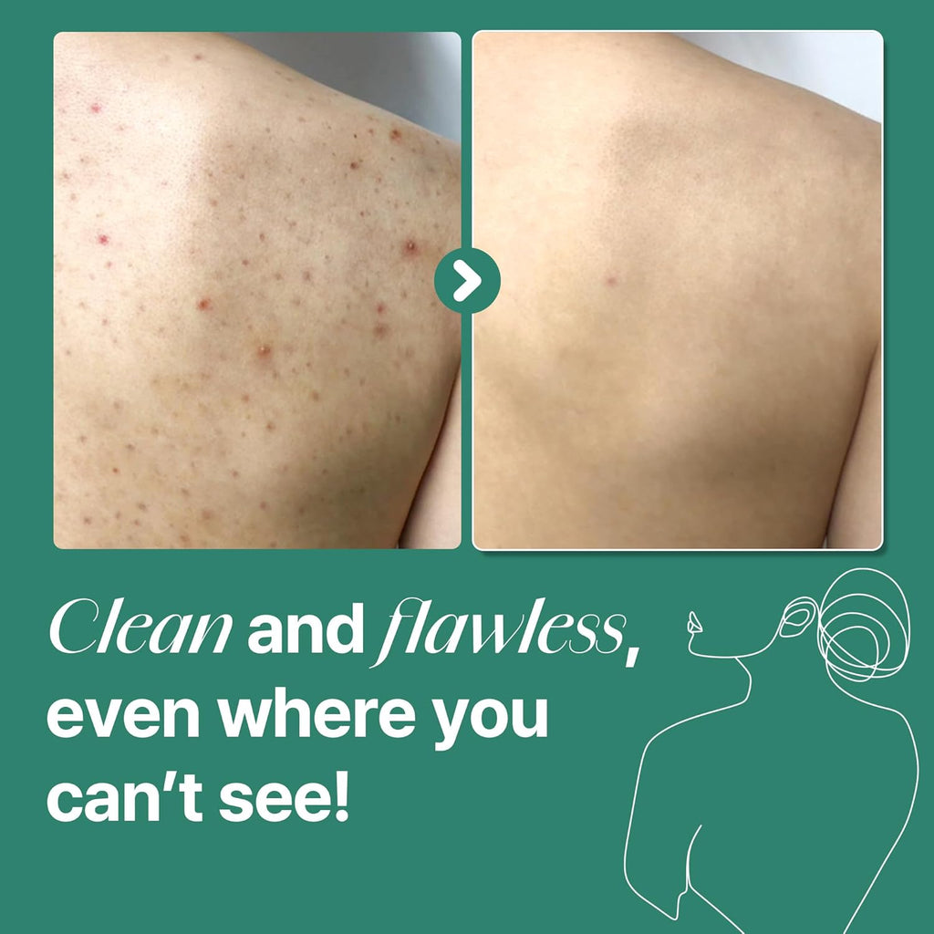 AHA BHA PHA Acne Body Wash  Deep Cleansing & Exfoliating