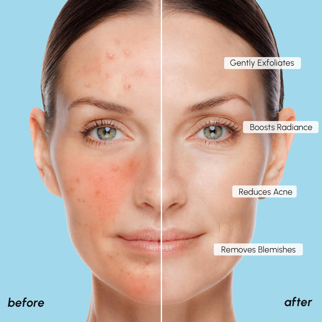 Glycolic Acid Exfoliating Pads  Acne & Pore Cleansing